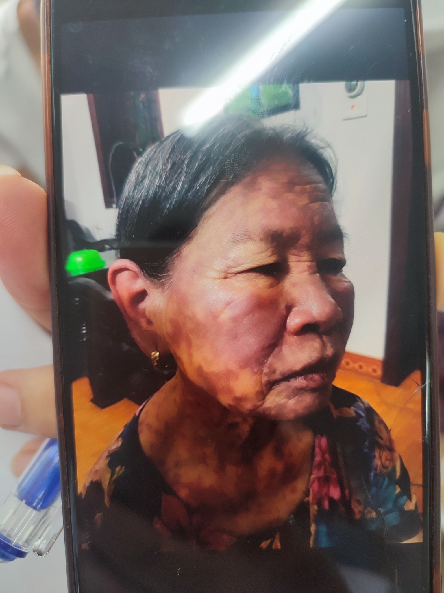 NHỮNG LƯU Ý VỀ HỘI CHỨNG STEVENS-JOHNSON️