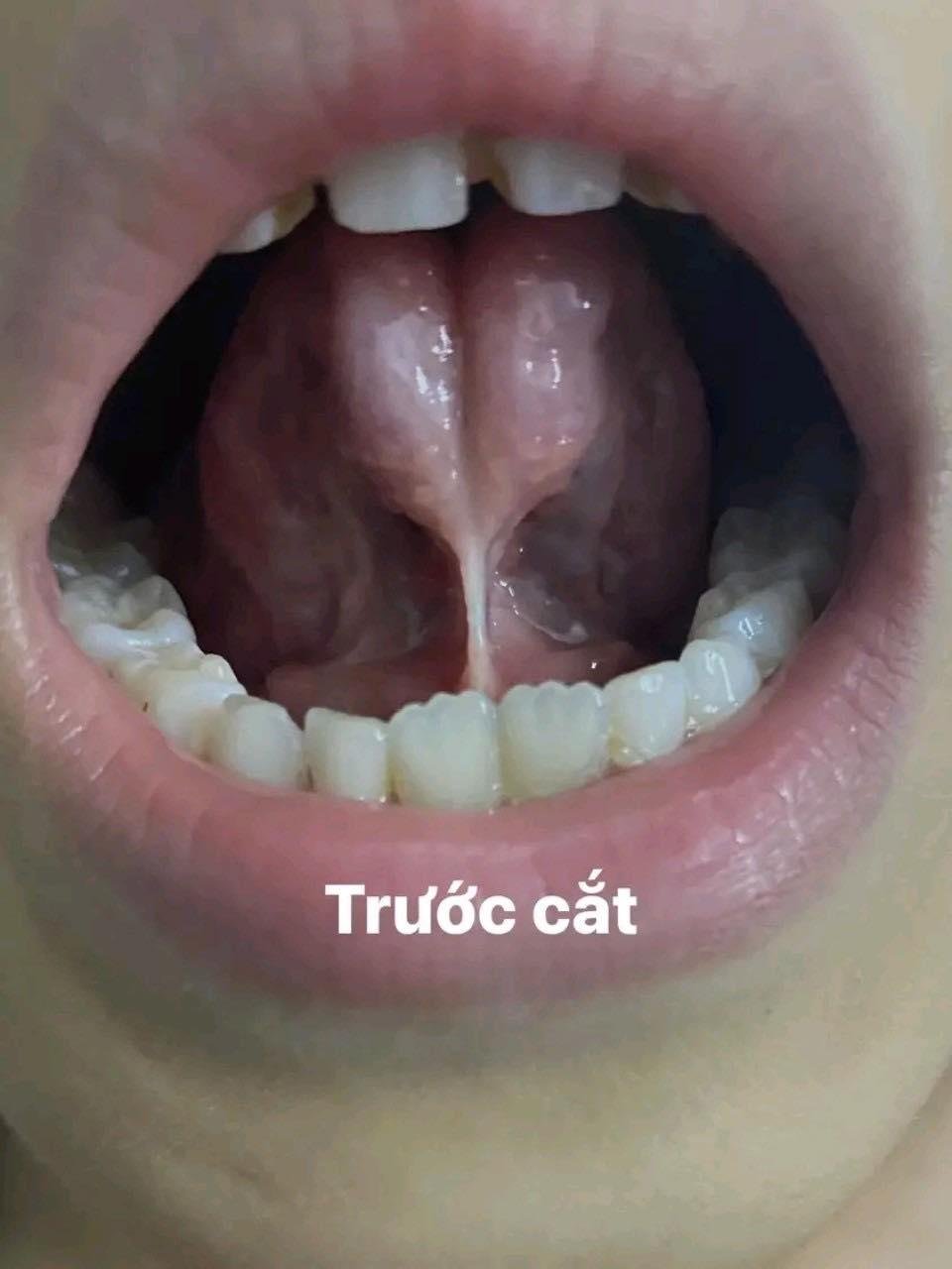 NGẮN HÃM LƯỠI – THỦ PHẠM KHIỂN TRẺ NÓI NGỌNG, KHÓ PHÁT ÂM